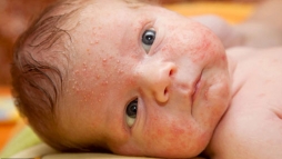 Акне новорожденных. А педиатры твердили что это аллергия.