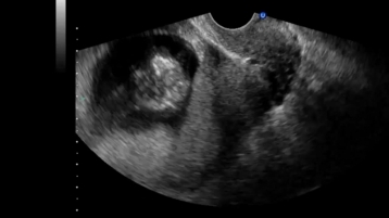 Ультразвуковая анатомия плода в I триместре беременности